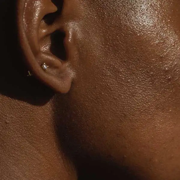 Woman with acne blemishes along her cheek