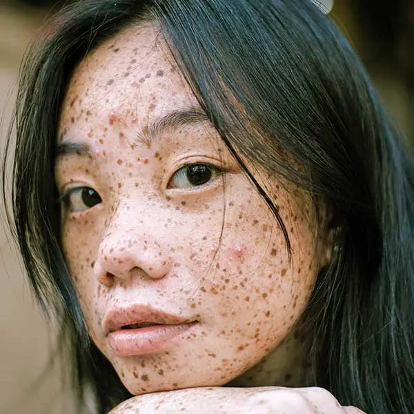 Young woman with acne blemished skin